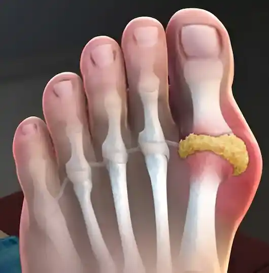 Severe gout inflammation in the big toe joint