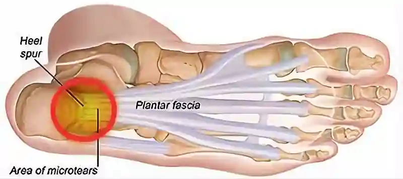Diagnostic illustration of Plantar Fasciitis and heel pain