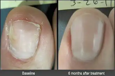 Toenail Laser Treatment