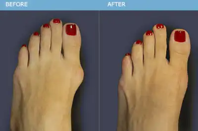 minimally invasive bunion surgery