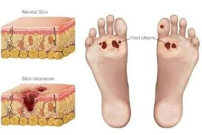Diabetic foot ulcer care in Irvine Orange County
