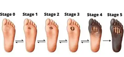 Diabetic foot ulcer progression stages
