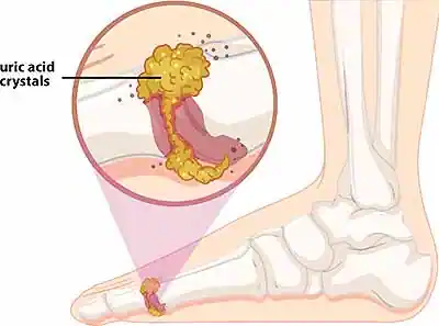 gout in foot causes