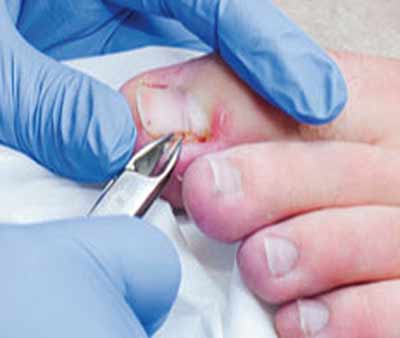 ingrown toenail surgery what's an ingrown toenail look like
