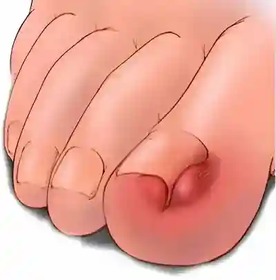 Laser ingrown toenail removal Irvine CA - Dr. Sima Soltani