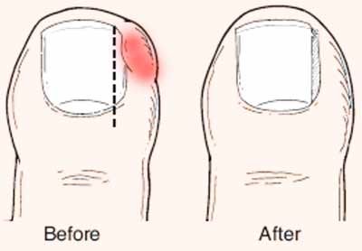 ingrown toenail laser Removal