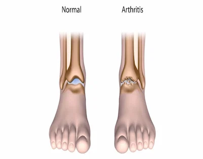 Stem cell therapy for foot and ankle arthritis in Irvine CA